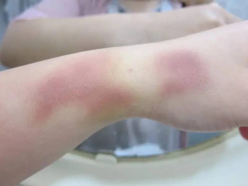 身上的乌青块是怎么形成的