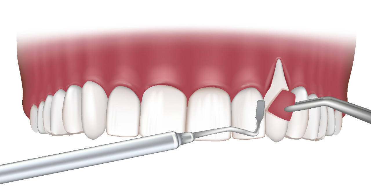 牙龈为什么会萎缩 如何预防牙龈退缩