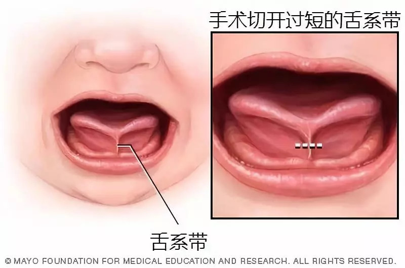 人有可能吞下自己的舌头吗